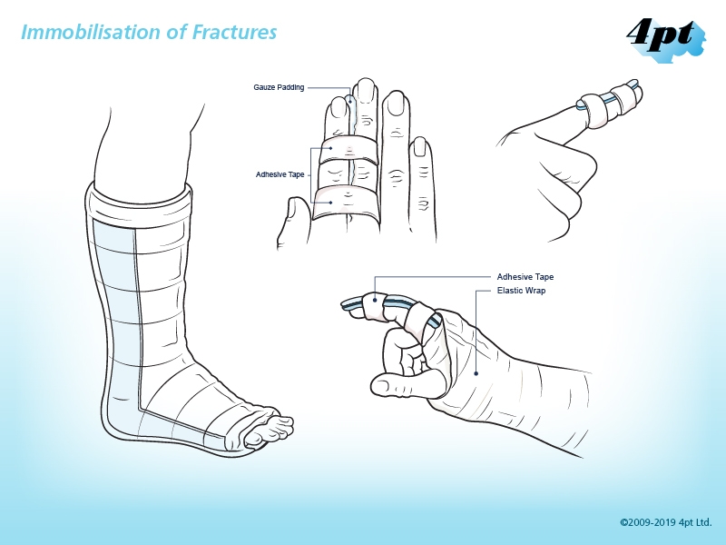 Immobilisation of fractures